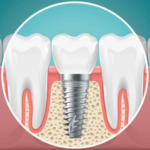 Dental Implants (Fixed teeth)