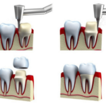 Crown Lengthening Procedures