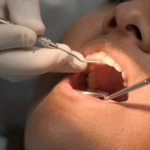 Root Canal Treatment