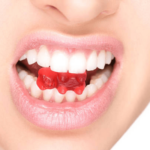 Treatment Of Gummy Smile