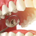 Dental Fillings